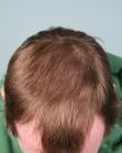 Before Hair Transplant&nbsp;Hairlines